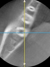 Corte axial de una tomografía CBCT en el visor de Oralink