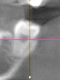 Corte coronal de una tomografía CBCT en el visor de Oralink