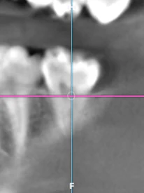 Corte sagital de una tomografía CBCT en el visor de Oralink